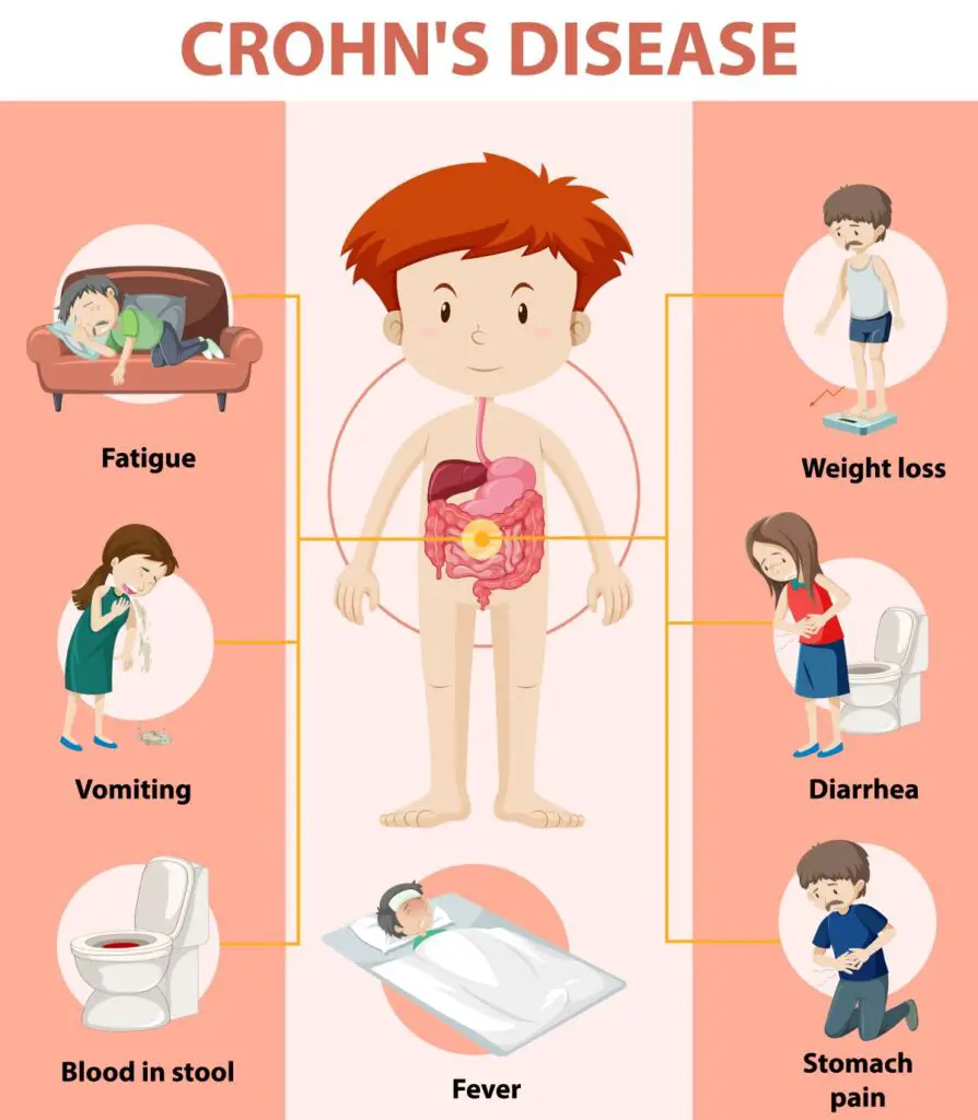 Symptoms of Crohn’s Disease
