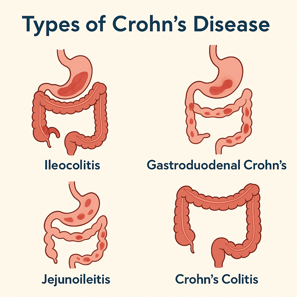 Types of Crohn’s Disease