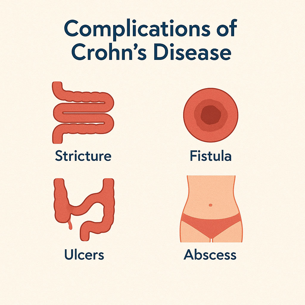 Complication of Crohn’s Disease: